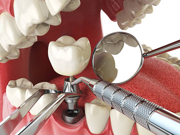 Best Emergency Dentist for Lost Fillings or Crowns in Shougal, WA