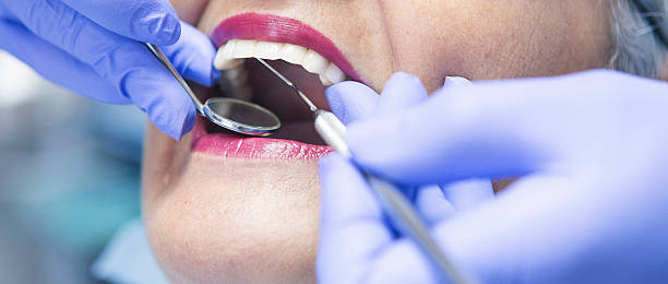 Best Emergency Dentist for Lost Fillings or Crowns in Shougal, WA